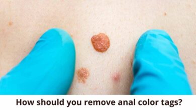 How should you remove anal color tags?