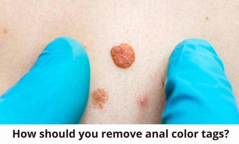 How should you remove anal color tags?