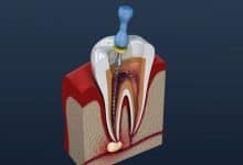 root-canals