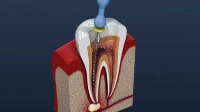 root-canals