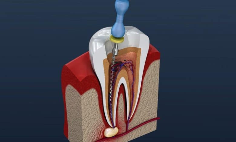 root-canals